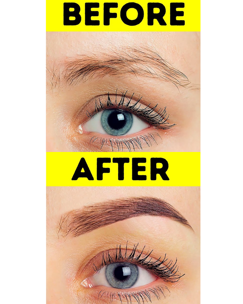 Before and After Eyebrow Hair Transplant