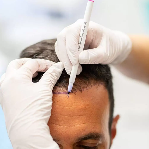 FUE Hair Transplant in Michigan