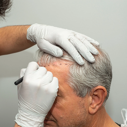 PRP Hair Treatment in Michigan