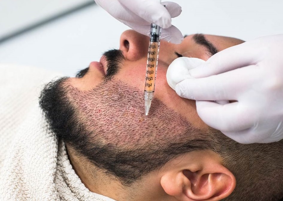 Beard Hair Transplant Michigan